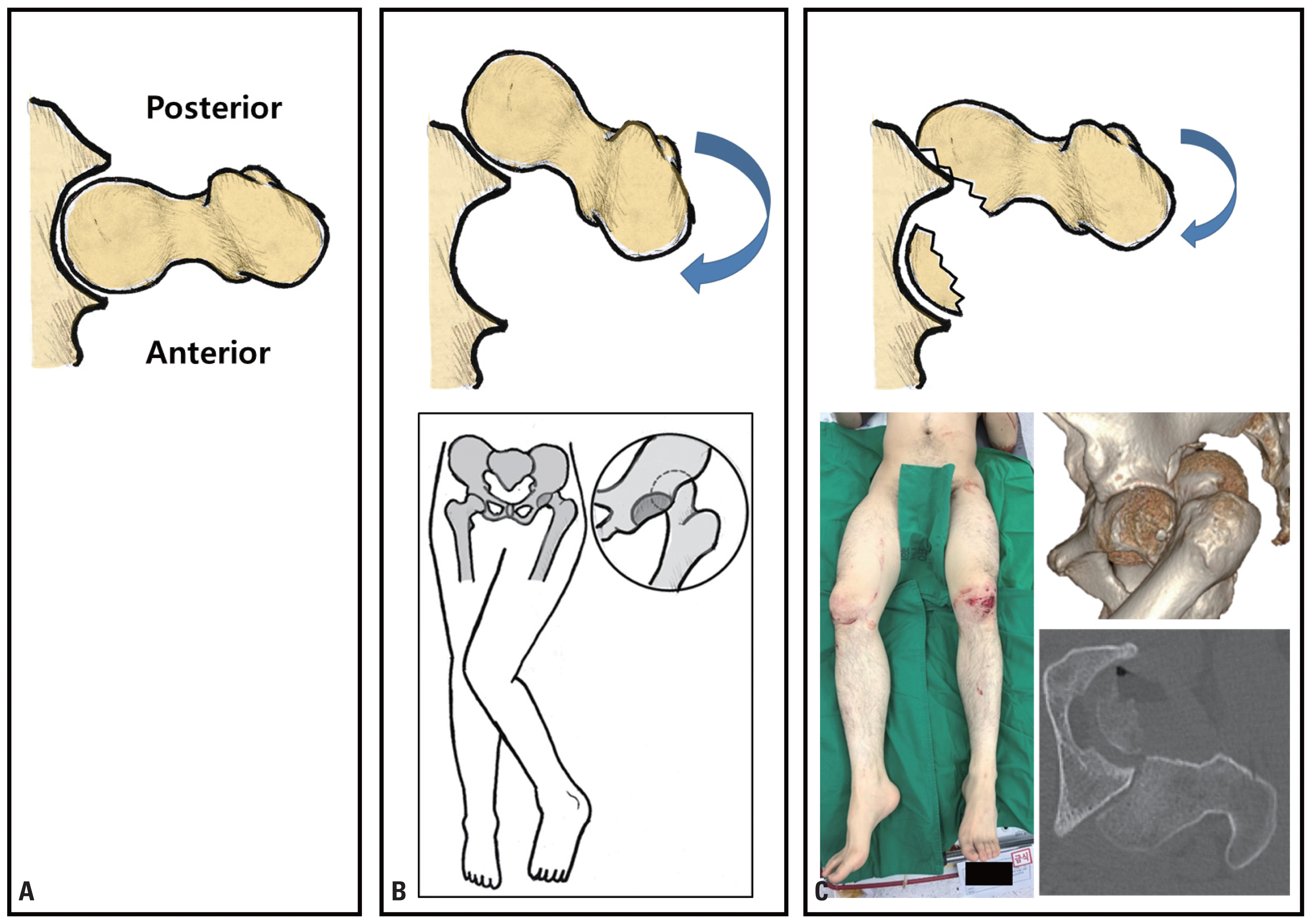 posterior hip dislocation presentation